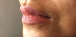 Dermal Fillers Before & After Photos