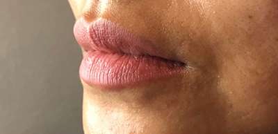 Dermal Fillers Before & After Photos