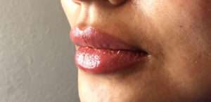 Dermal Fillers Before & After Photos