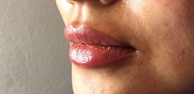 Dermal Fillers Before & After Photos