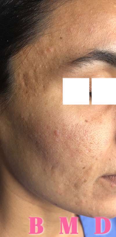 Skin Microneedling Before & After Photos