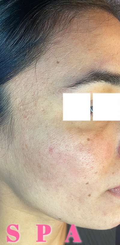 Skin Microneedling Before & After Photos