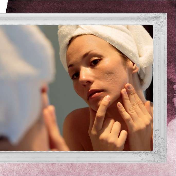 Treating The Scars of Acne: