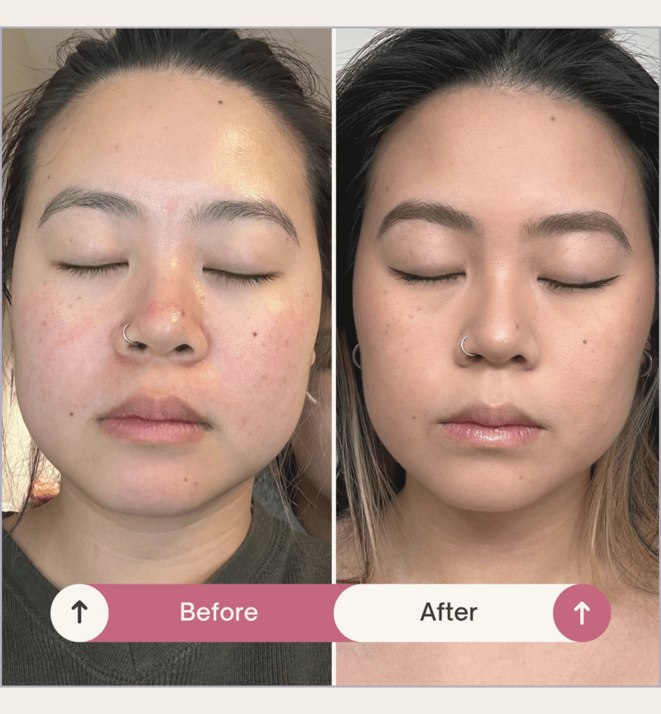 Masseter-Botox-Tik-Tok-Trend-Before-and-After-BlossomMD-San-Ramon