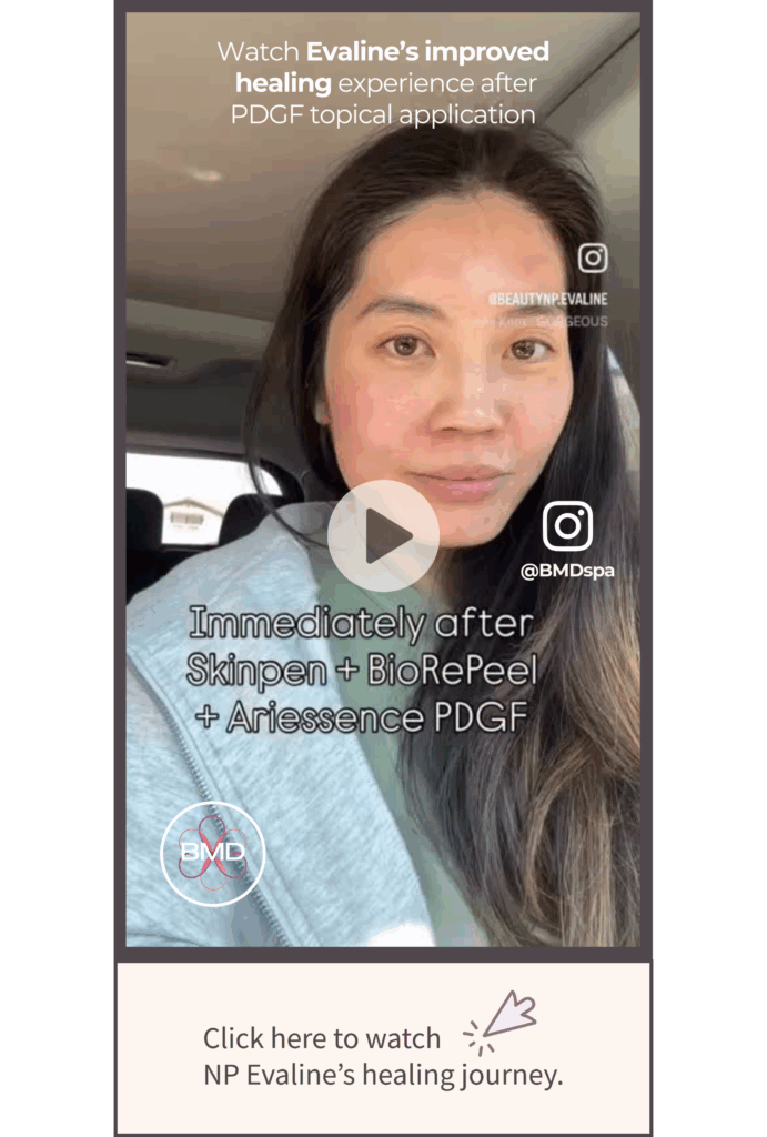 How Ariessence PDGF Enhances Healing After Skin Treatments: NP Evaline’s Personal Experience 2 Nurse Practitioner Evaline demonstrating Ariessence PDGF treatment after SkinPen microneedling and BioRePeel.