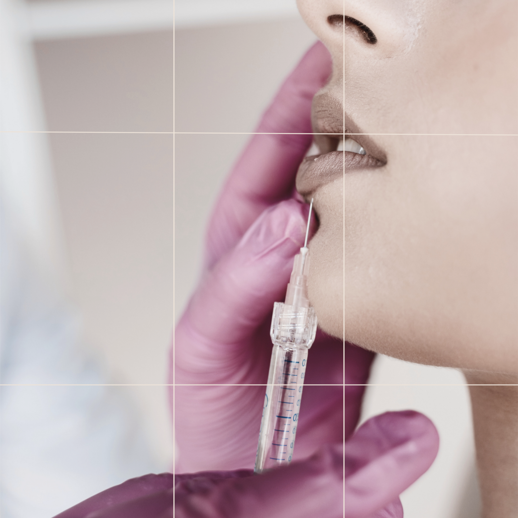 Lip Filler San Ramon CA — natural hyaluronic acid results with subtle enhancement