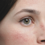 Redness vs. Rosacea. Laser Genesis or HydraFacial MD with red light therapy for calming facial redness at BlossomMD