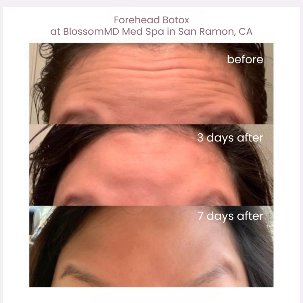 Progression of Botox results on Sophia, Office Manager at BlossomMD in San Ramon, showing forehead lines softening over a treatment series with visibly smoother, more relaxed skin.