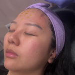 BioRePeel-no-peel-chemical-peel-San-Ramon-CA-BlossomMD-Med-Spa