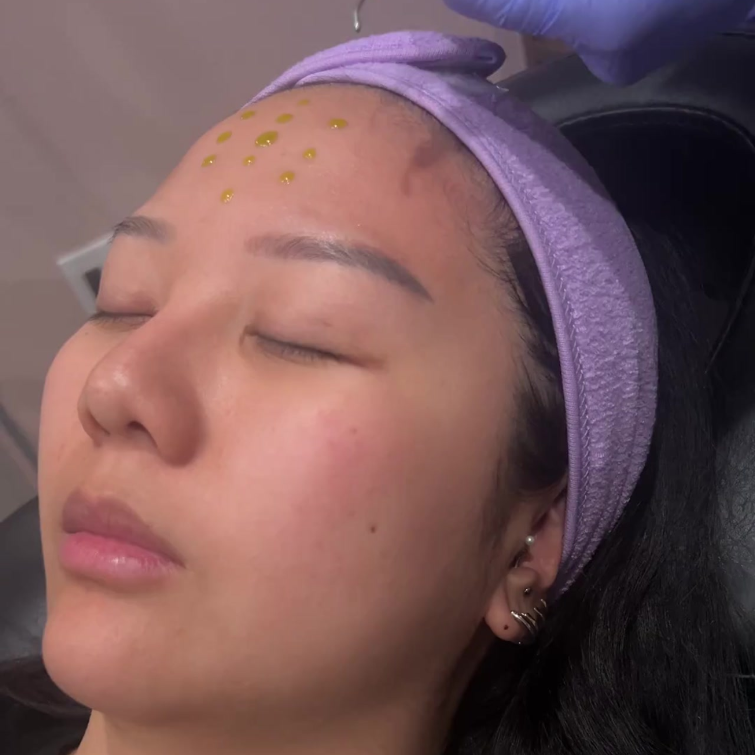 BioRePeel-no-peel-chemical-peel-San-Ramon-CA-BlossomMD-Med-Spa
